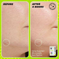 Revolution Skincare Spot Patches Microneedle Super Dart 9 Pieces