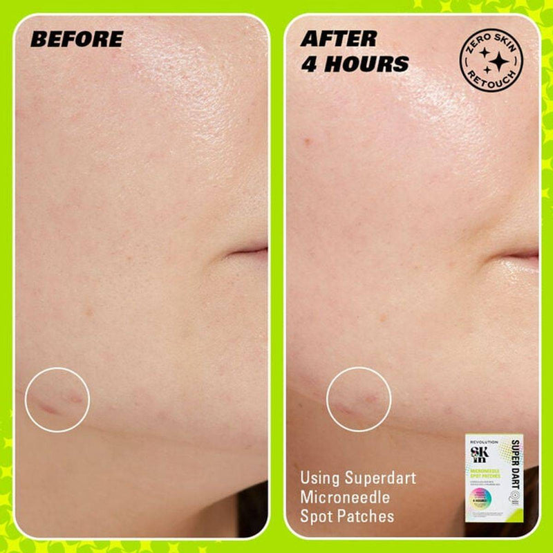 Revolution Skincare Spot Patches Microneedle Super Dart 9 Pieces
